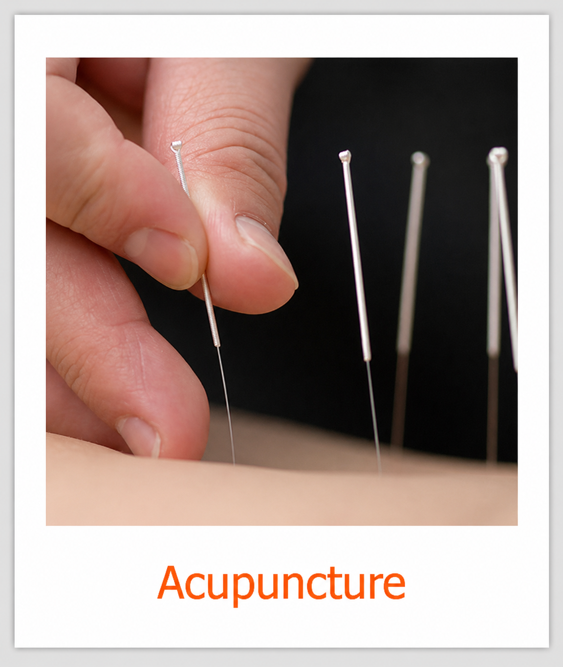 acupuncture2